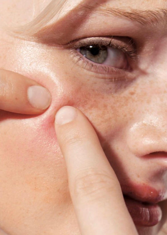 Acne Facial
